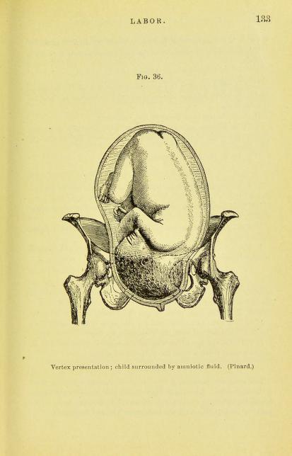 Plate from Ashton's Essentials of Obstetrics (1896): https://archive.org/details/b20387908